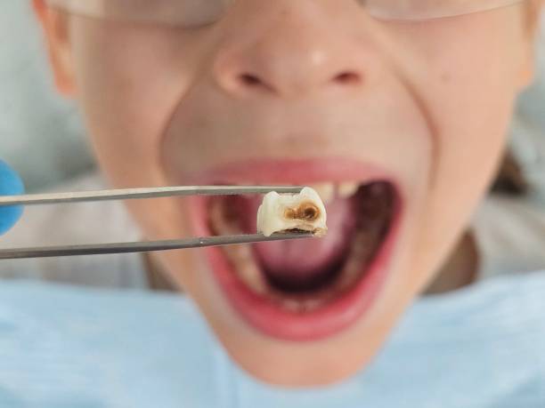 Best Emergency Treatment for Dental Infections or Abscesses in Big Bass Lake, PA